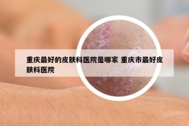 重庆最好的皮肤科医院是哪家 重庆市最好皮肤科医院