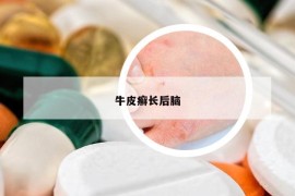 牛皮癣长后脑