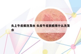 头上牛皮癣洗发水 头皮牛皮肤癣用什么洗发水