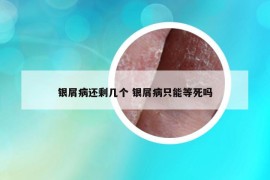 银屑病还剩几个 银屑病只能等死吗