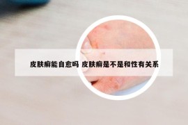 皮肤癣能自愈吗 皮肤癣是不是和性有关系