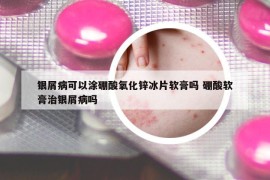 银屑病可以涂硼酸氧化锌冰片软膏吗 硼酸软膏治银屑病吗