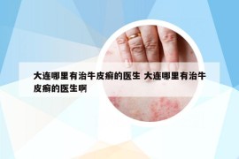 大连哪里有治牛皮癣的医生 大连哪里有治牛皮癣的医生啊