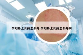 孕妇身上长藓怎么办 孕妇身上长藓怎么办啊