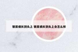 银屑病长到头上 银屑病长到头上会怎么样