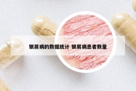 银屑病的数据统计 银屑病患者数量