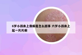 6岁小孩身上像癣是怎么回事 六岁小孩身上起一片片癣