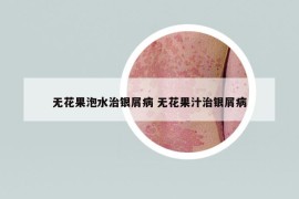 无花果泡水治银屑病 无花果汁治银屑病