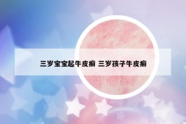三岁宝宝起牛皮癣 三岁孩子牛皮癣