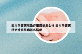 四川华西医院治疗银屑病怎么样 四川华西医院治疗银屑病怎么样啊