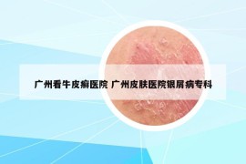 广州看牛皮癣医院 广州皮肤医院银屑病专科