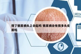 得了银屑病头上会起吗 银屑病会有很多头皮屑吗