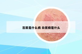 百屑是什么病 白屑癣是什么