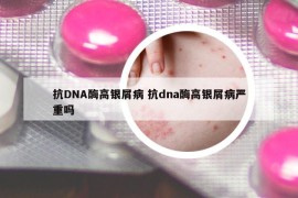 抗DNA酶高银屑病 抗dna酶高银屑病严重吗