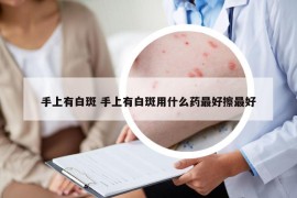手上有白斑 手上有白斑用什么药最好擦最好