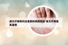 维方疗癣真的还是假的陕西西安 维方疗癣是真是假