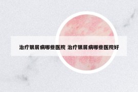 治疗银屑病哪些医院 治疗银屑病哪些医院好