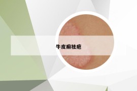 牛皮癣祛疤