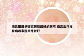 南昌银屑病哪家医院最好的医院 南昌治疗皮肤病哪家医院比较好