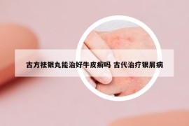 古方祛银丸能治好牛皮癣吗 古代治疗银屑病