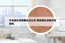 牛皮癣吃消银颗粒怎么样 银屑病吃消银片管用吗