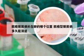 脓疱银屑病长在脚的哪个位置 脓疱型银屑病多久能消退