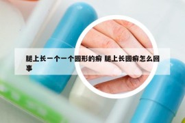 腿上长一个一个圆形的癣 腿上长圆癣怎么回事