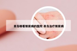 青岛哪看银屑病的医院 青岛治疗银屑病