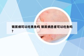 银屑病可以吃黑鱼吗 银屑病患者可以吃鱼吗?