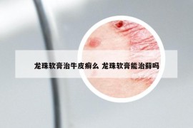 龙珠软膏治牛皮癣么 龙珠软膏能治藓吗