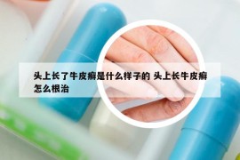 头上长了牛皮癣是什么样子的 头上长牛皮癣怎么根治