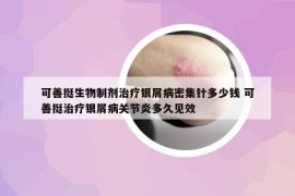 可善挺生物制剂治疗银屑病密集针多少钱 可善挺治疗银屑病关节炎多久见效