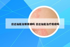 日达仙能治银屑病吗 日达仙能治疗癌症吗