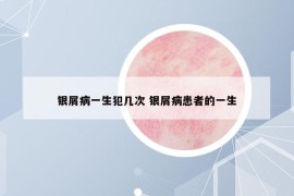银屑病一生犯几次 银屑病患者的一生