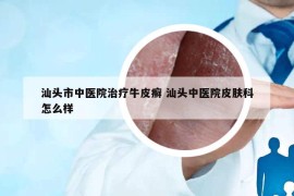 汕头市中医院治疗牛皮癣 汕头中医院皮肤科怎么样