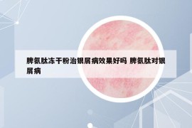 脾氨肽冻干粉治银屑病效果好吗 脾氨肽对银屑病