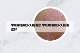 掌趾脓包病多久能治愈 掌趾脓包病多久能治愈好