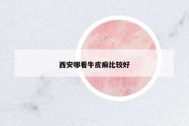 西安哪看牛皮癣比较好