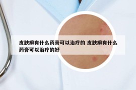 皮肤癣有什么药膏可以治疗的 皮肤癣有什么药膏可以治疗的好