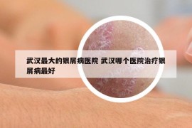 武汉最大的银屑病医院 武汉哪个医院治疗银屑病最好