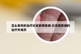 怎么有效的治疗红皮肤银屑病 红皮银屑病的治疗外用药