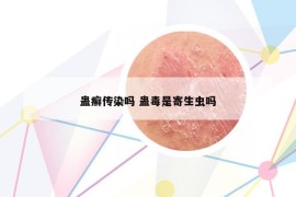蛊癣传染吗 蛊毒是寄生虫吗