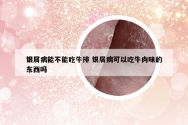 银屑病能不能吃牛排 银屑病可以吃牛肉味的东西吗