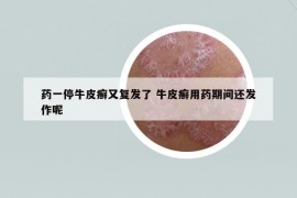 药一停牛皮癣又复发了 牛皮癣用药期间还发作呢