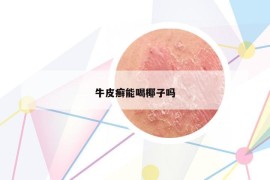 牛皮癣能喝椰子吗