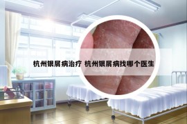 杭州银屑病治疗 杭州银屑病找哪个医生