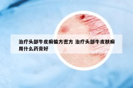 治疗头部牛皮癣偏方密方 治疗头部牛皮肤癣用什么药膏好