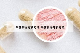 牛皮癣治好的方法 牛皮癣治疗新方法