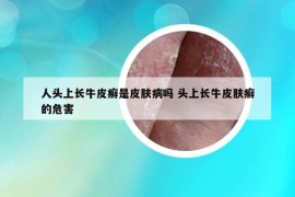 人头上长牛皮癣是皮肤病吗 头上长牛皮肤癣的危害