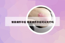 银屑病怀孕后 银屑病怀孕后可以光疗吗